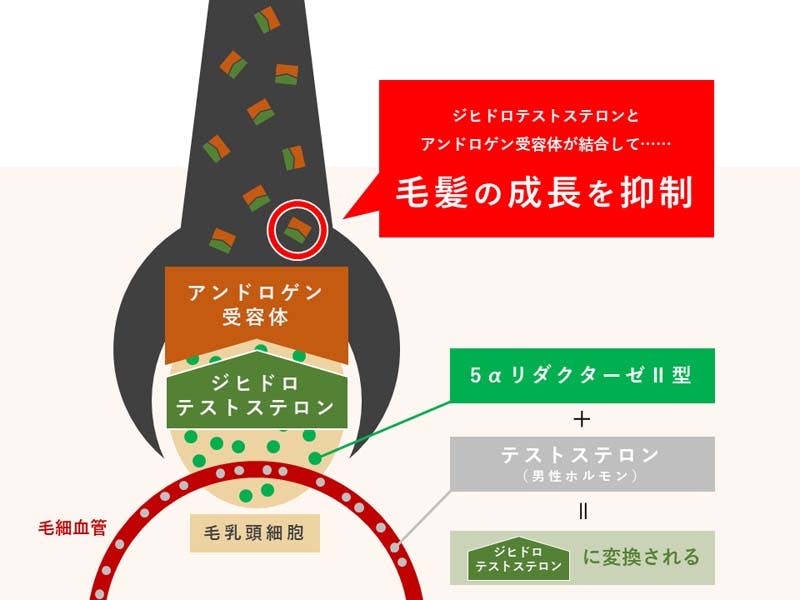 テストステロンと5αリダクターゼ(Ⅱ型)が髪の毛の成長を抑制する仕組みのイメージ図