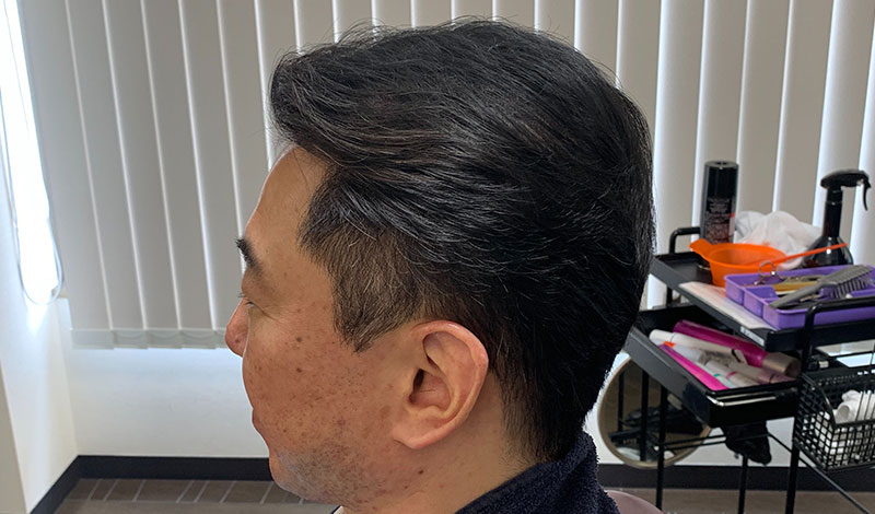 施術モデルアフター 左