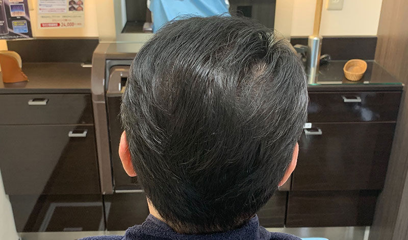 施術モデルアフター 真後ろ